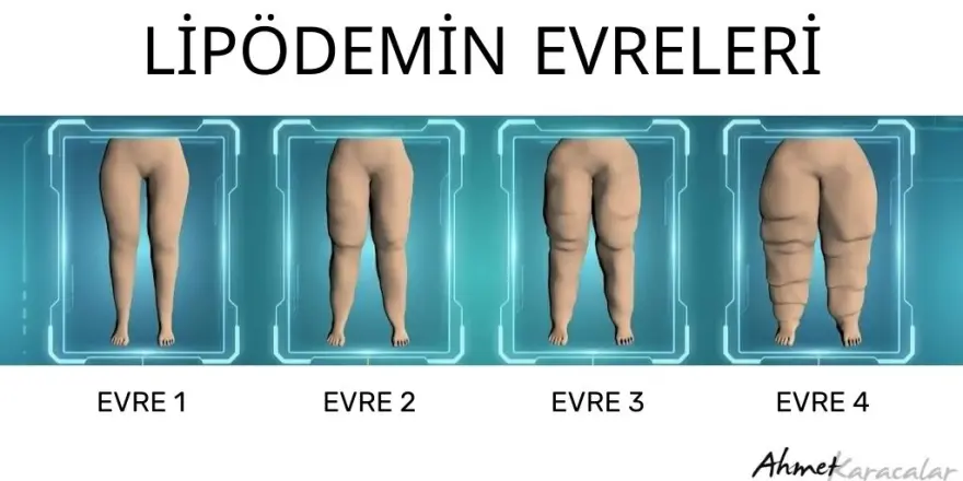 Kilo Veremiyorsanız Suçlu İradeniz Değil, Lipödem Olabilir