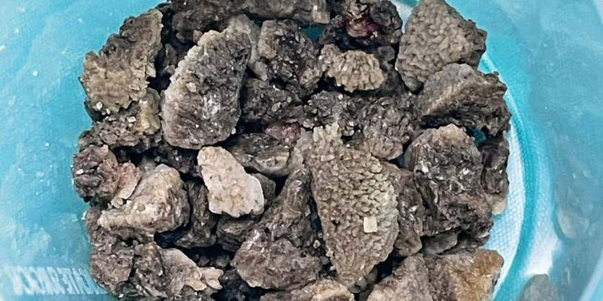 Malatya’da 8 Santimetrelik Böbrek Taşı Kapalı Yöntemle Alındı