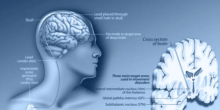 Parkinson Hastalığı Tedavisinde Beyin Pili Yöntemi